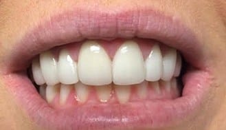 Brilliant white top front teeth