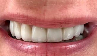 Flawles smile after treatment