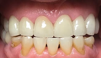Flawlessly restored and healthy smile