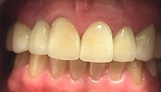 Repaired healthy smile