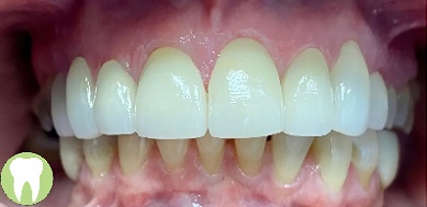 Healthy beautiful smile after treatment