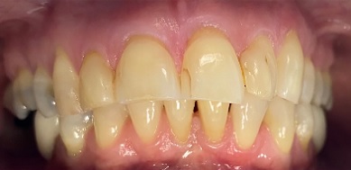 Yellowed and damaged front teeth