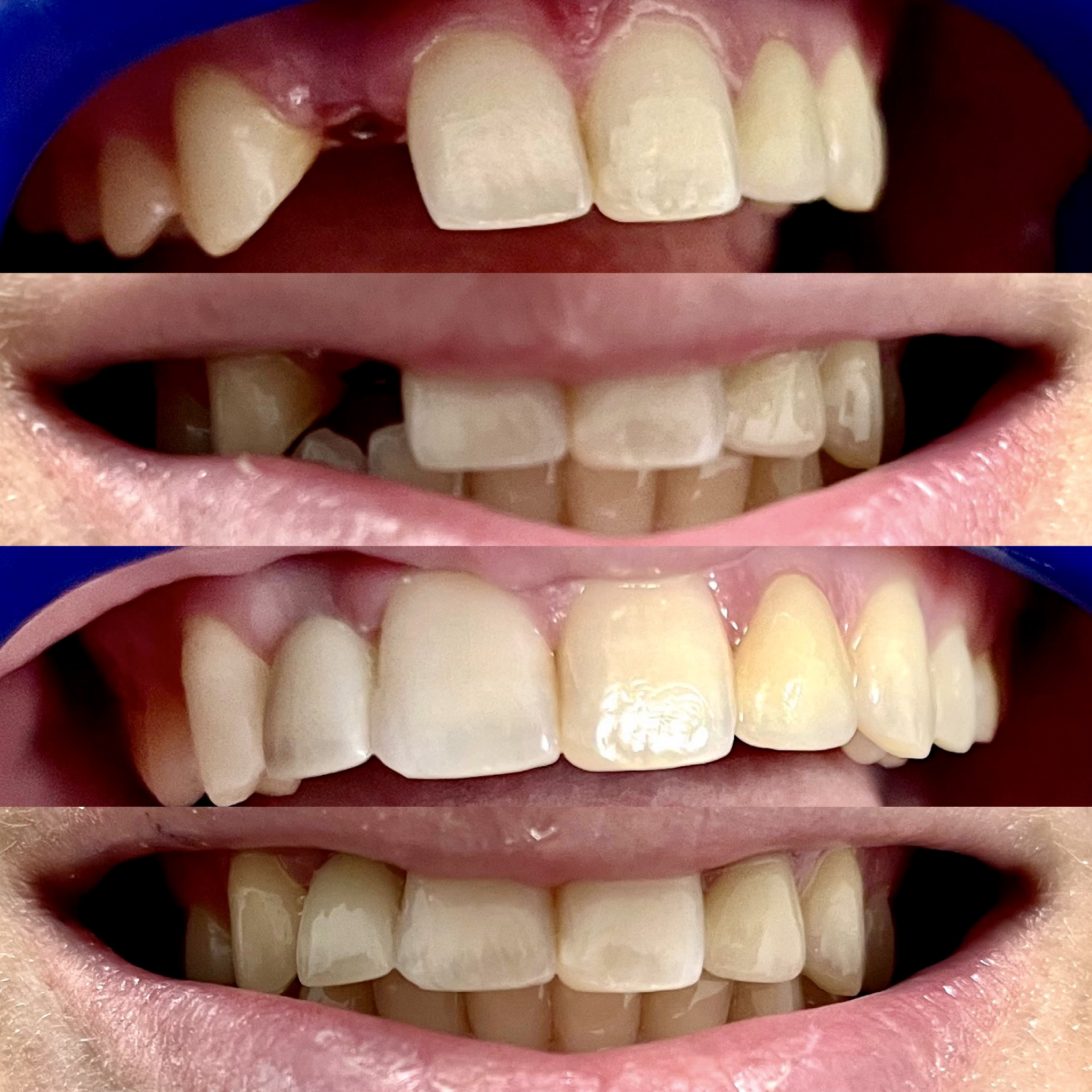 Yellowed and damaged front teeth