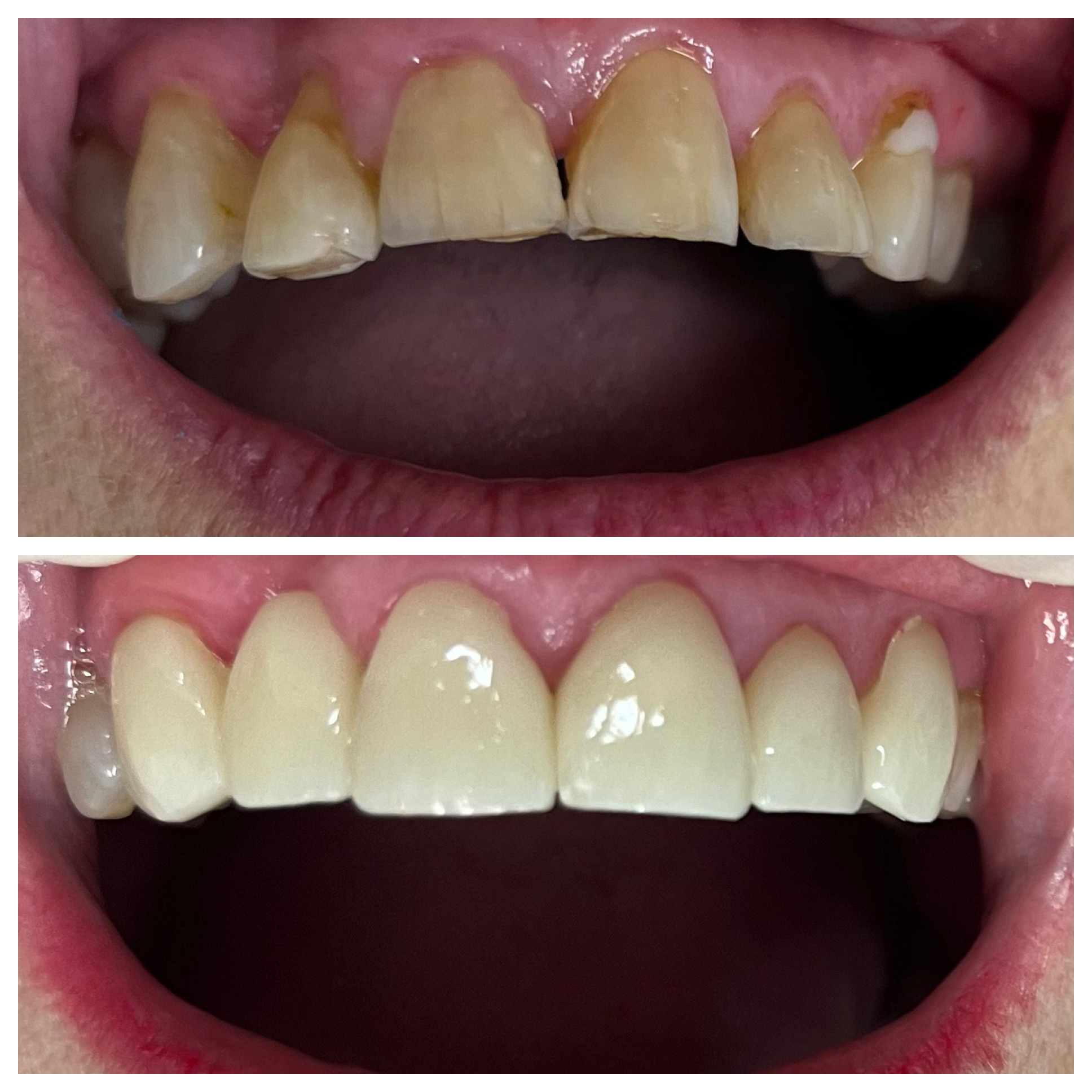 Yellowed and damaged front teeth