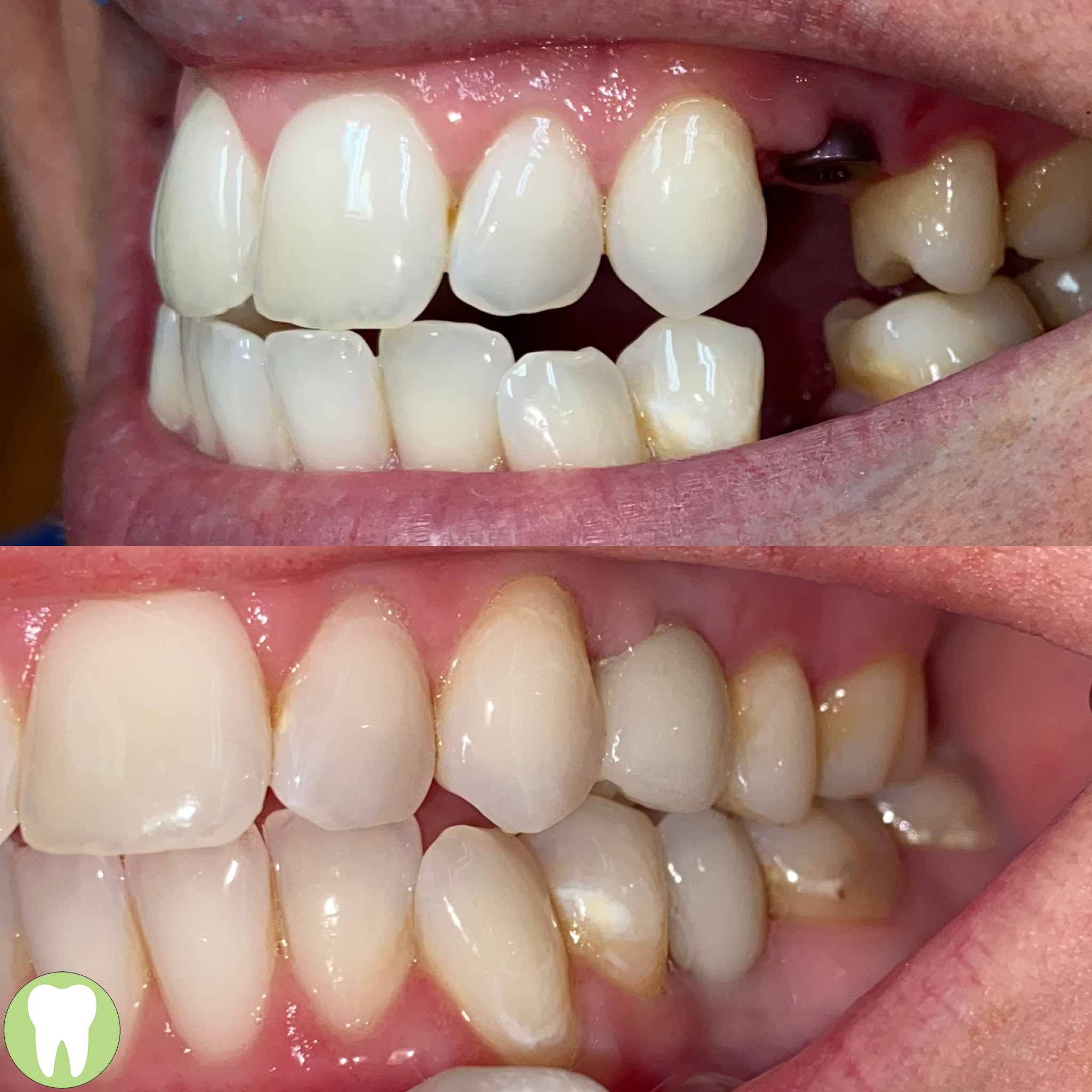 Yellowed and damaged front teeth