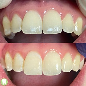 Yellowed and damaged front teeth