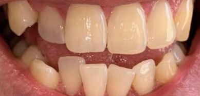 Yellowed and damaged front teeth