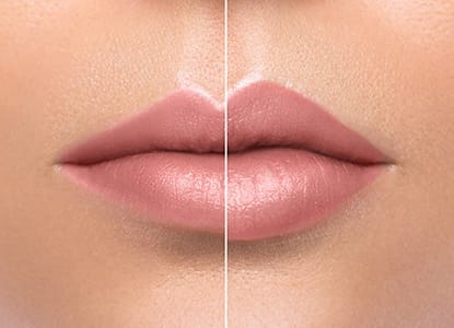 Mouth before and after lip fillers