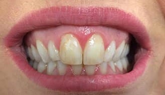 Discolored top front teeth