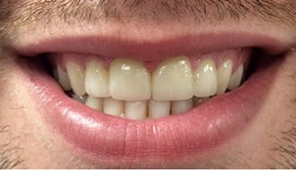 Gap between top two front teeth closed