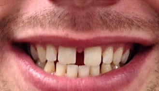 Large gap between top front two teeth