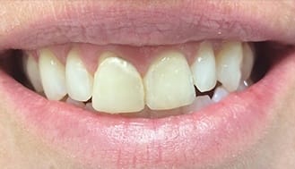 Yellowed and damaged front teeth