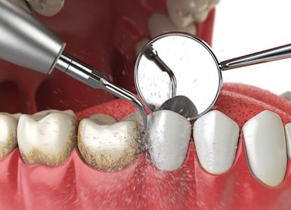 Animation of dental cleaning process