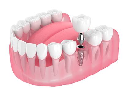 A digital image of a single tooth dental implant being placed on the lower arch