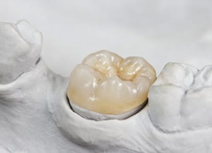 A crown sitting in a dental mold.