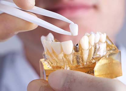dentist placing a crown on top of a dental implant in a model of the jaw