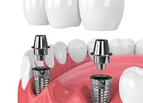two dental implants restored with a dental bridge