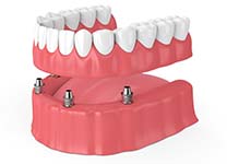 four dental implants restored with a full denture