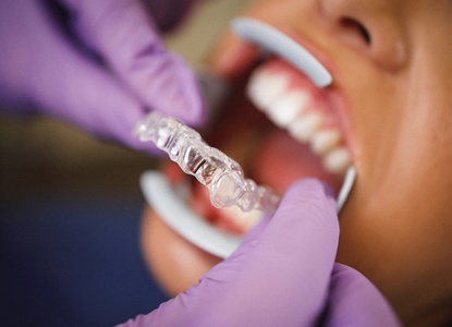 An up-close image of a dentist fitting a patient with an Invisalign aligner