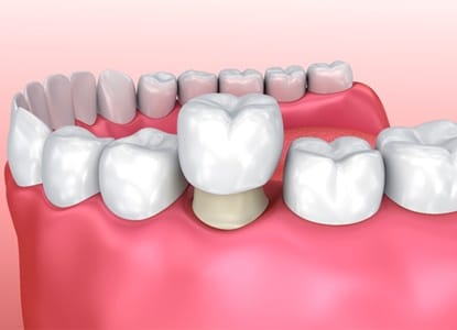 Illustration of porcelain crown being placed on tooth