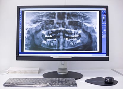 Panoramic digital dental x-rays on computer screen