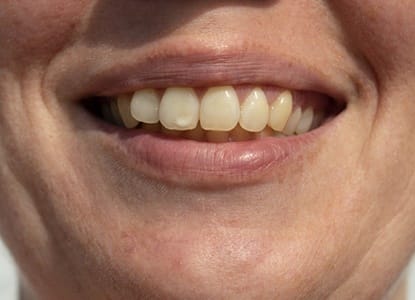 Discolored teeth