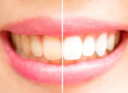 Smile before and after teeth whitening